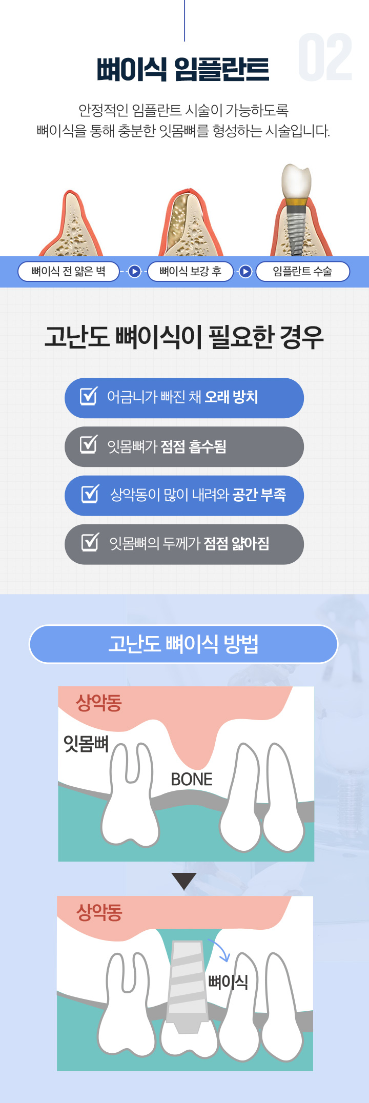 뼈이식 임플란트