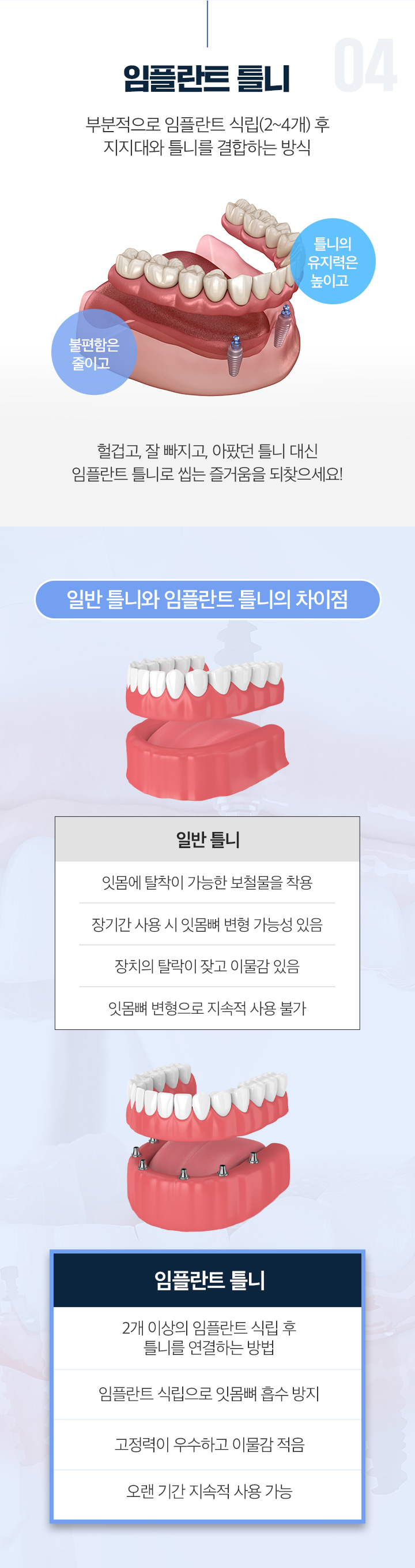 임플란트 틀니